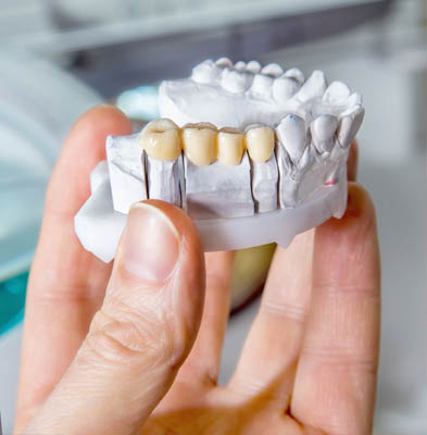What To Do When Your Dental Crown Falls Out